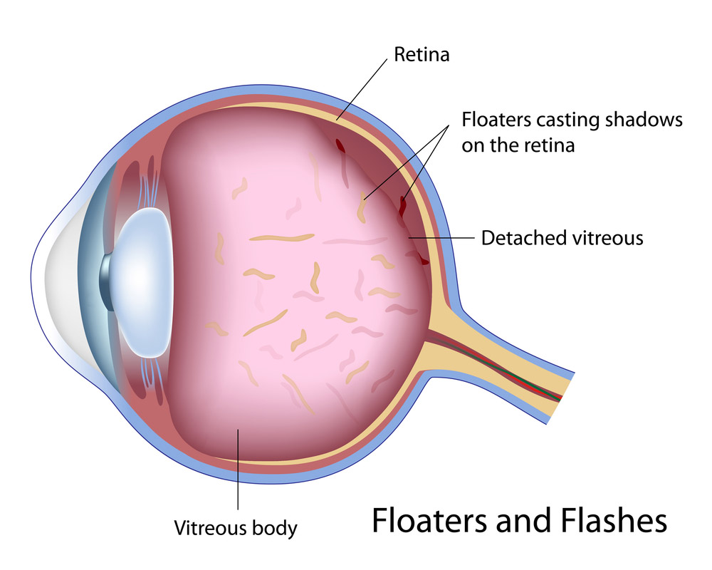Illustration of Floaters & Flashes